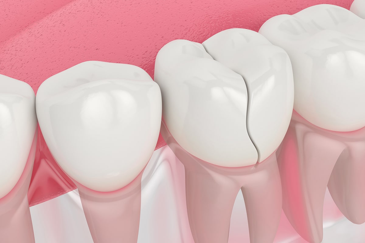 Can a cracked tooth heal on its own blog