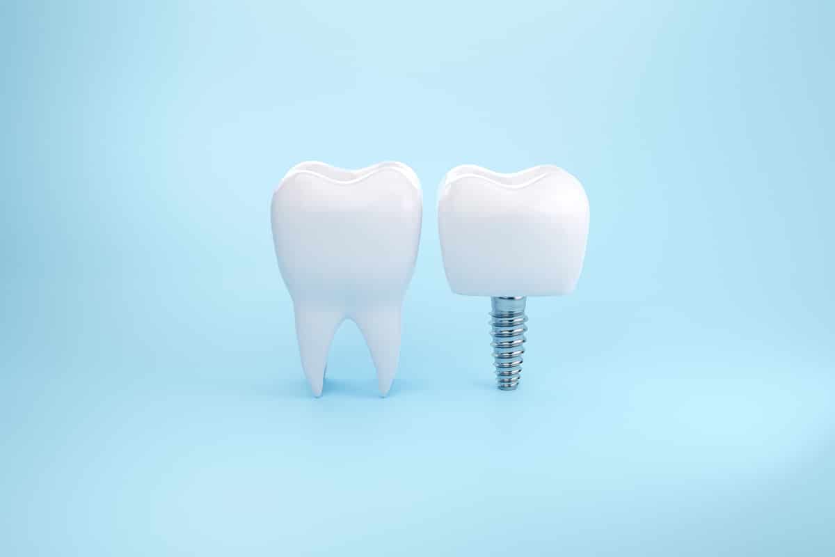 Dental implants vs root canal why saving your natural tooth is often the smarter choice blog