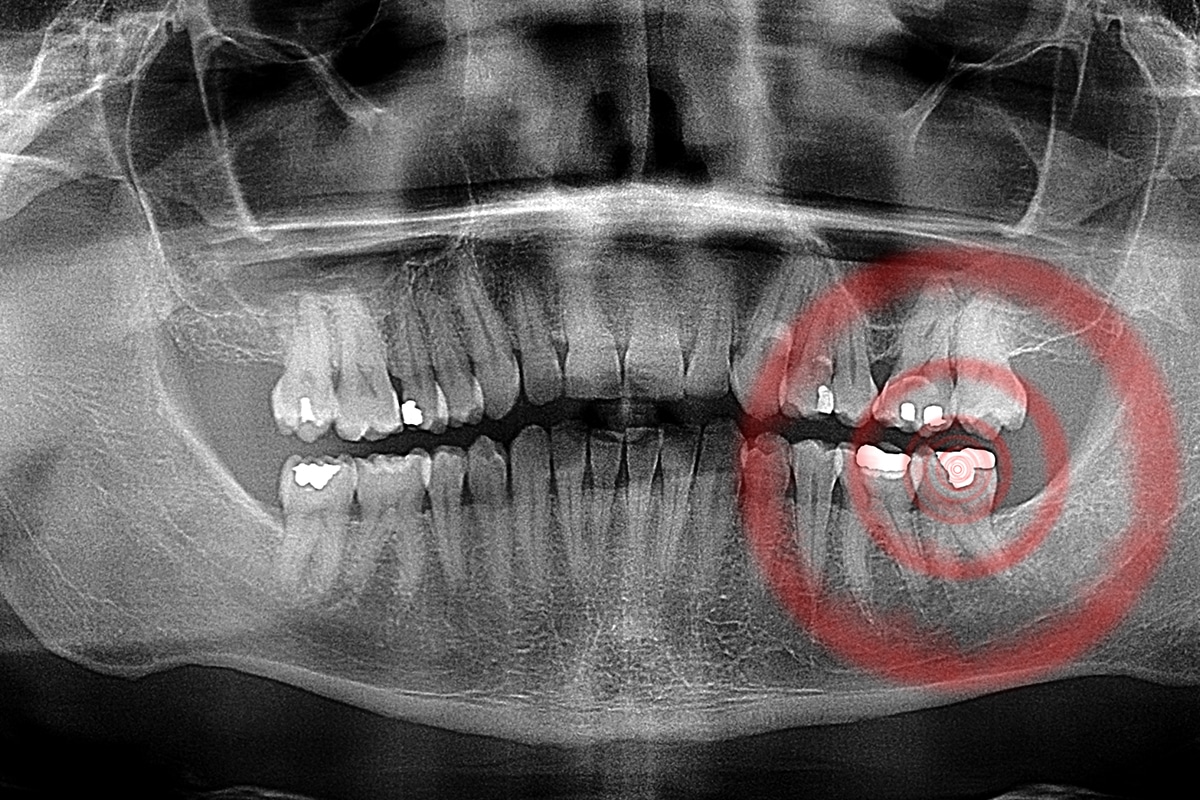 How does an infected tooth cause bone loss blog