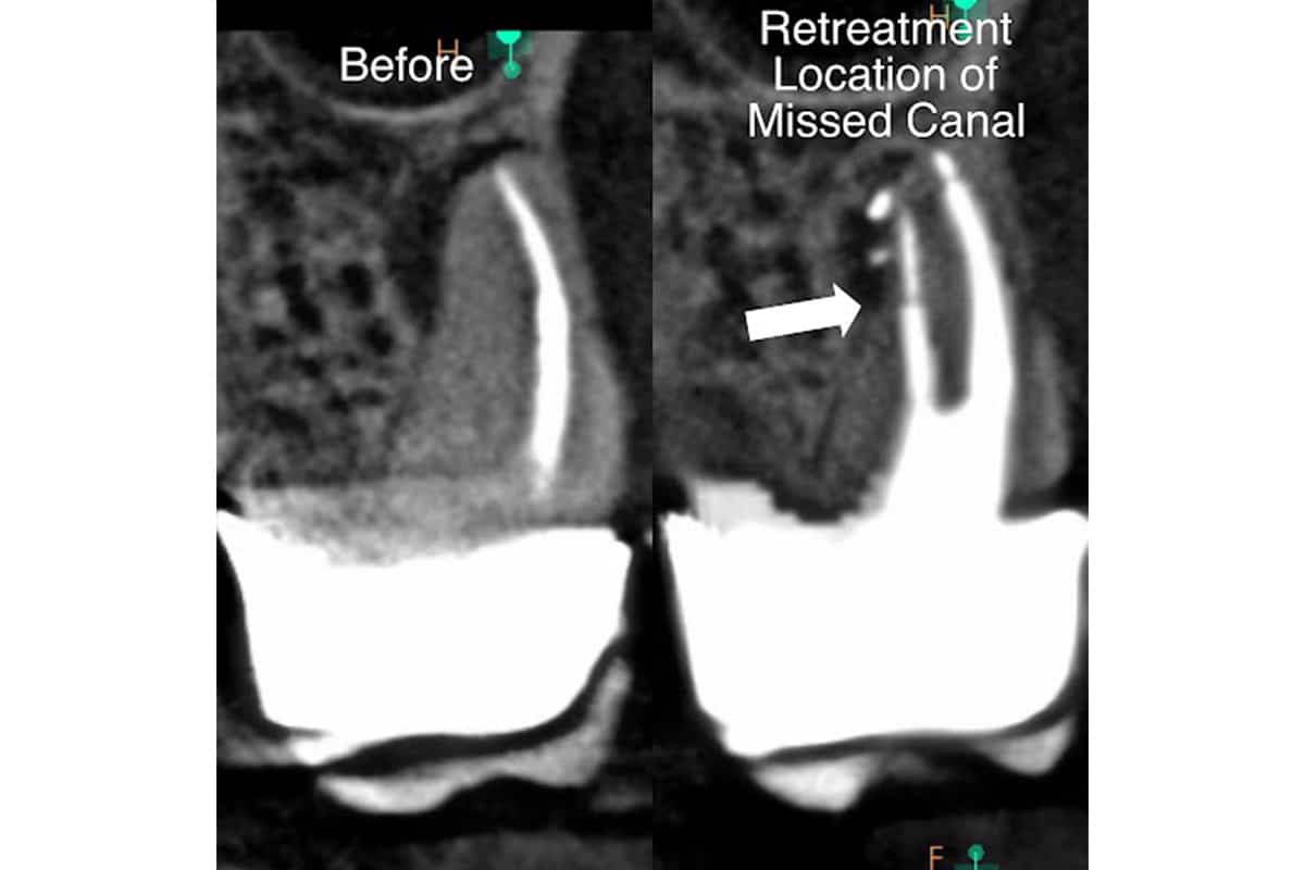 When root canal retreatment is necessary blog